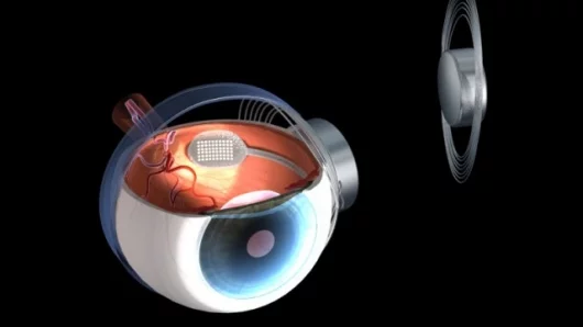 Argus retinal impant