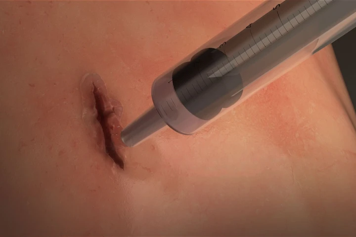 Once squirted into the wound, the MeTro glue is said to behave much like the silicone sealants used around bathroom tiles