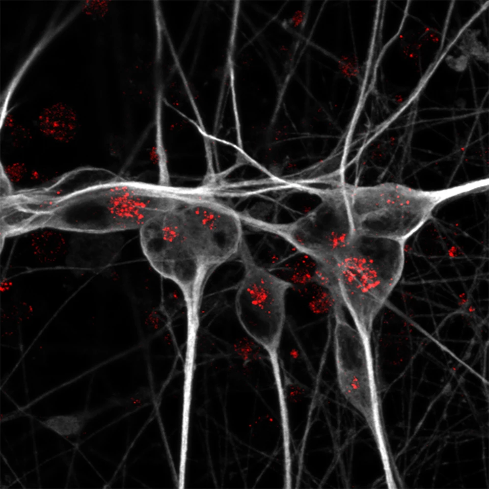 The "normal" (APOE3) variant allows lipids used by neurons for energy; the APOE4 variant stops that happening