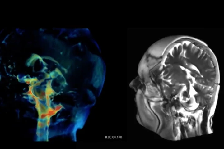 The detail in these new 3D aMRI visualizations may be able to help identify abnormalities, such as those caused by blockages of spinal fluids, which include blood and spinal fluid in the brain