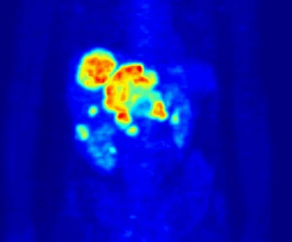 A PET scan of a patient, showing normal accumulation of the tracer dye in the heart and kidneys, as well as a tumor in the liver
