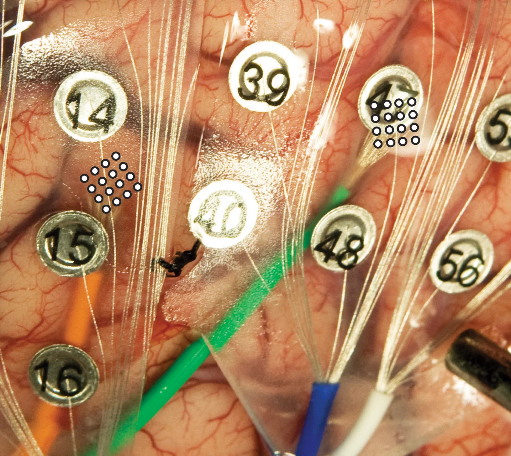 Larger, numbered button-like electrodes (ECoGs) alongside the microECoGs indicated by the 4x4 circle grid at the end of the green and orange wires on the brain of a volunteer patient (Image: University of Utah Department of Neurosurgery)