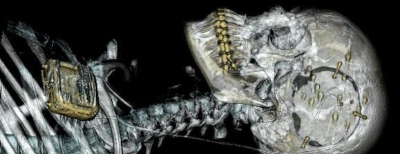 The system includes implants in the head and chest and a hand-held device