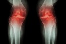A new study has found a way to regrow cartilage