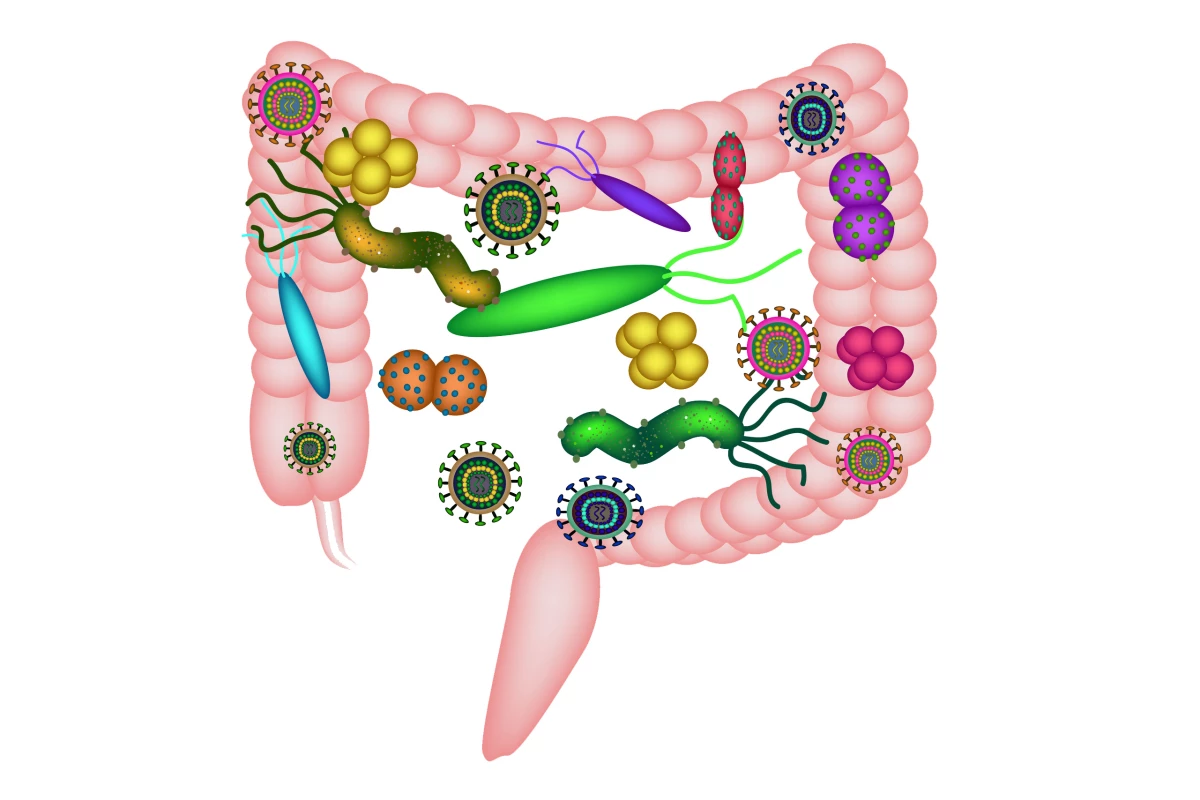 A new study suggests greater levels of a specific type of gut bacteria can increase a person's bowel cancer risk by up to 15 percent