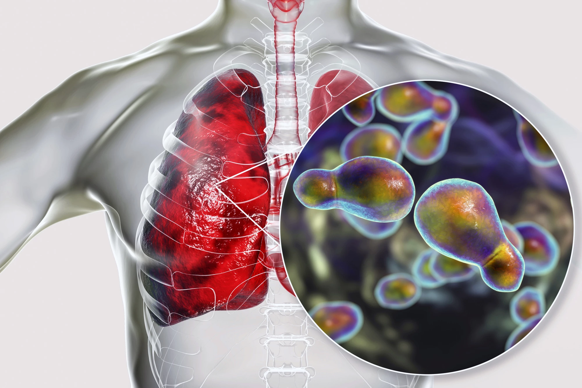Breathed into the lungs, the fungus Cryptococcus neoformans can travel to the brain and cause meningitis