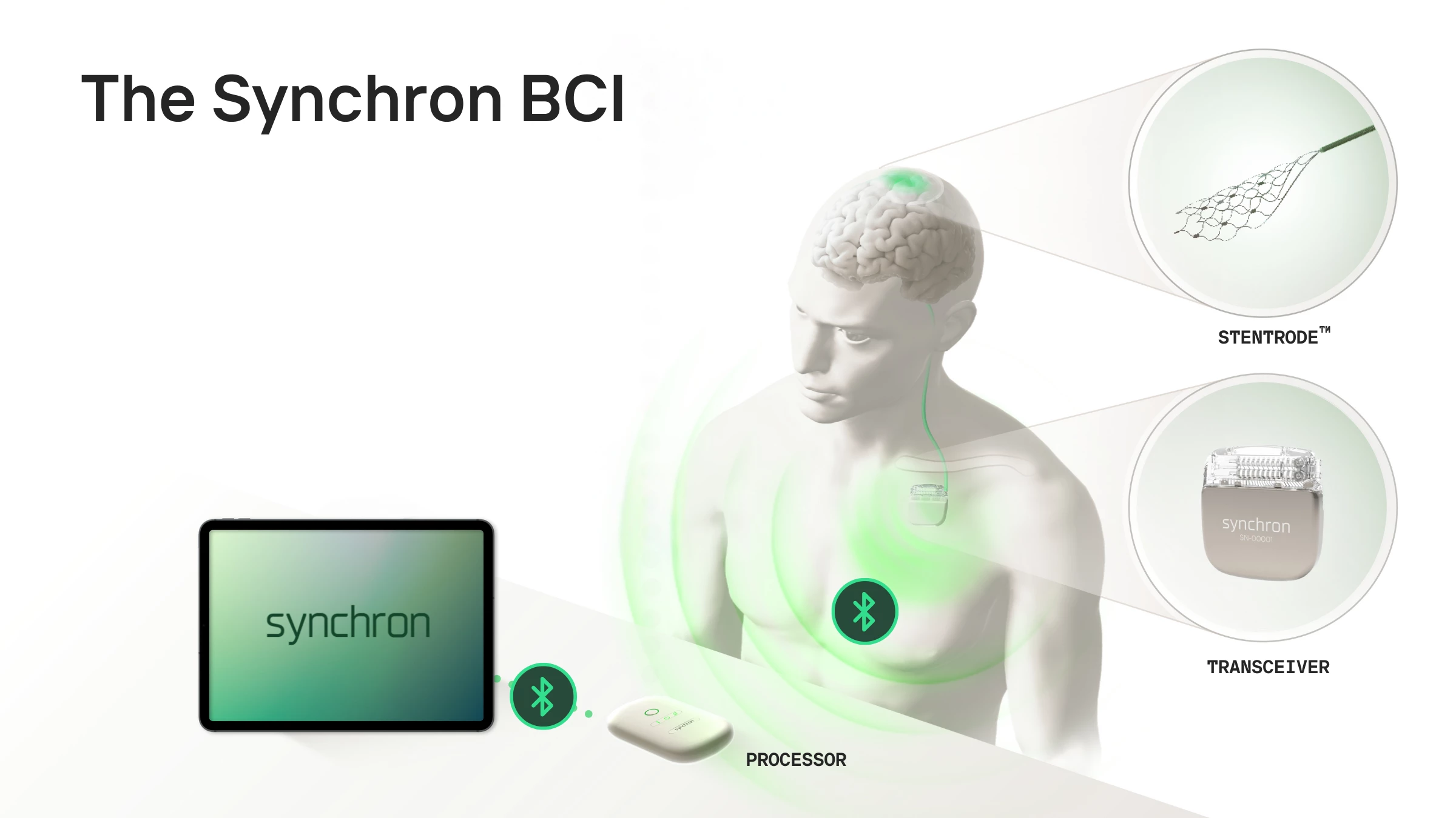 The Synchron BCI consisting of a Stentrode threaded through a blood vessel, a wearable transceiver at its other end and a wireless processor to turn brain signals into commands for devices