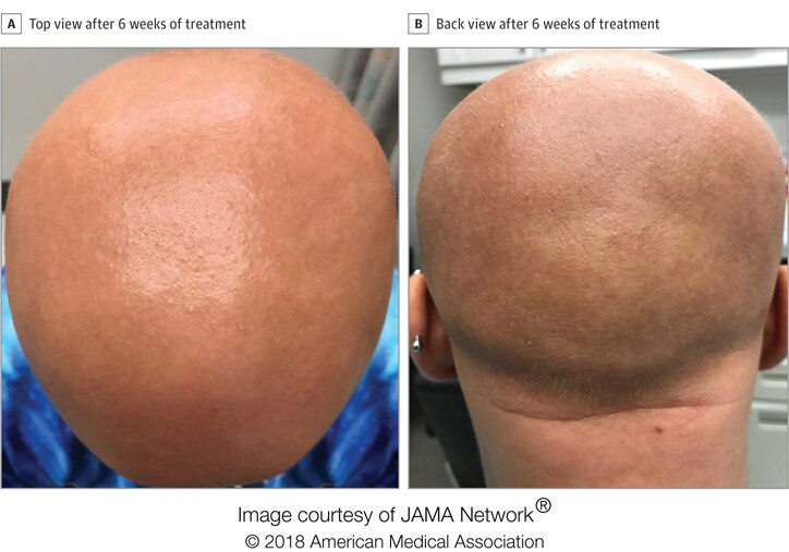 Before any treatment, and six weeks are treatment commenced