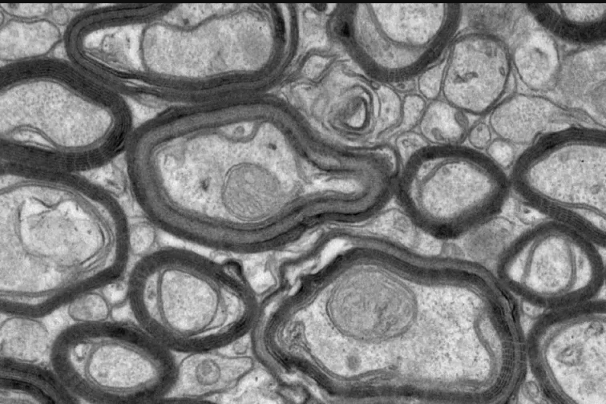 A new synthetic peptide called TDP6 helps regenerate myelin damaged by MS