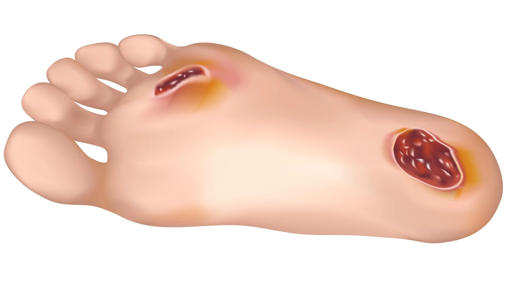 Plans call for the lamp to be tested on diabetic ulcers within 12 months