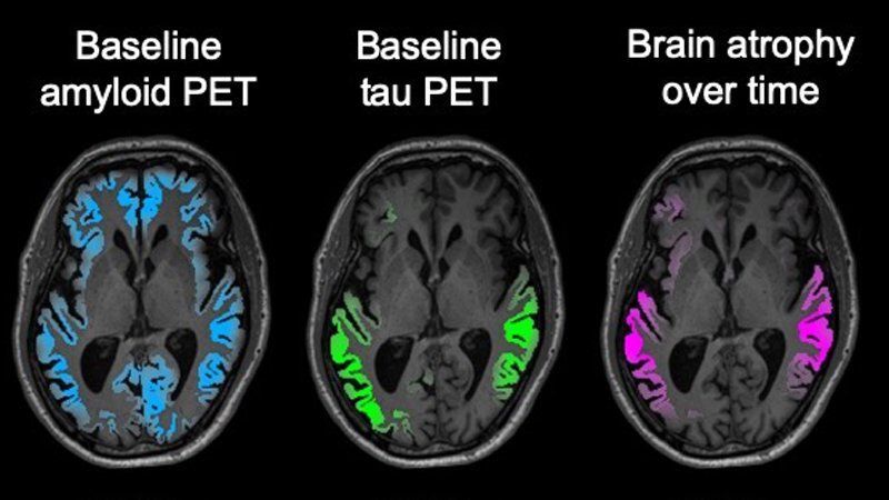 This image clearly shows how effectively the tau PET scans can predict the location of neurodegeneration