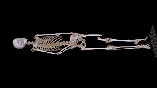 Notable fractures: on the right foot, left tibia and fibula, right knee and left femoral shaft, fractured jaw and a broken vertebra