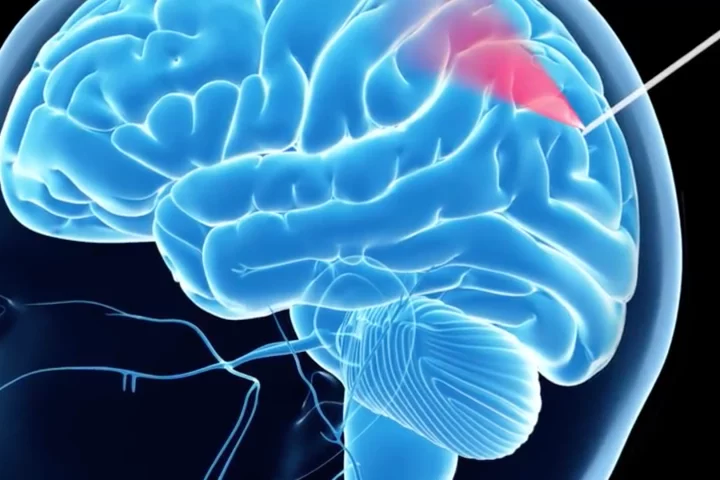 The researchers say this is the first time in the world that this technology has been used on humans