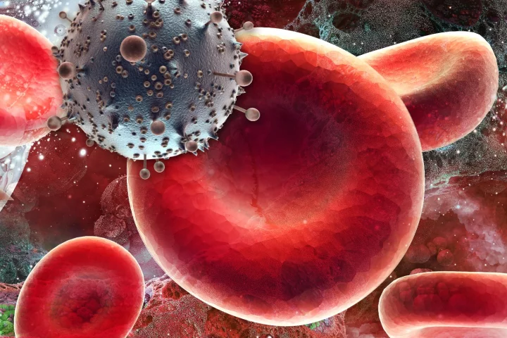Scientists are reporting the second known case of HIV remission in the world, after stem cell treatment