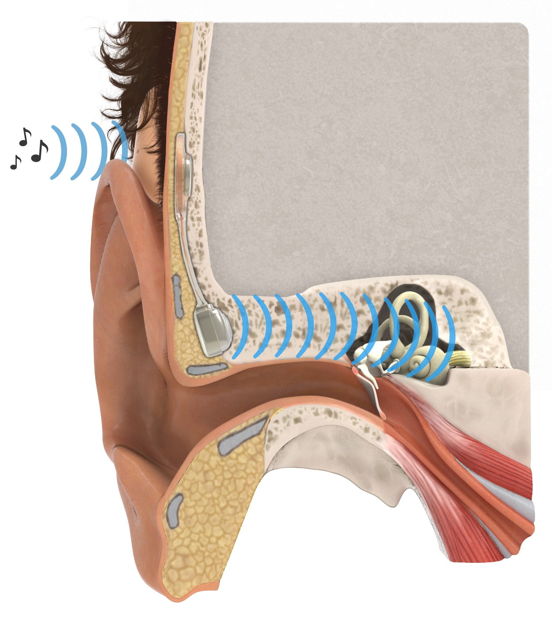 Implanted hearing aid uses bone conduction to bypass defective middle ear