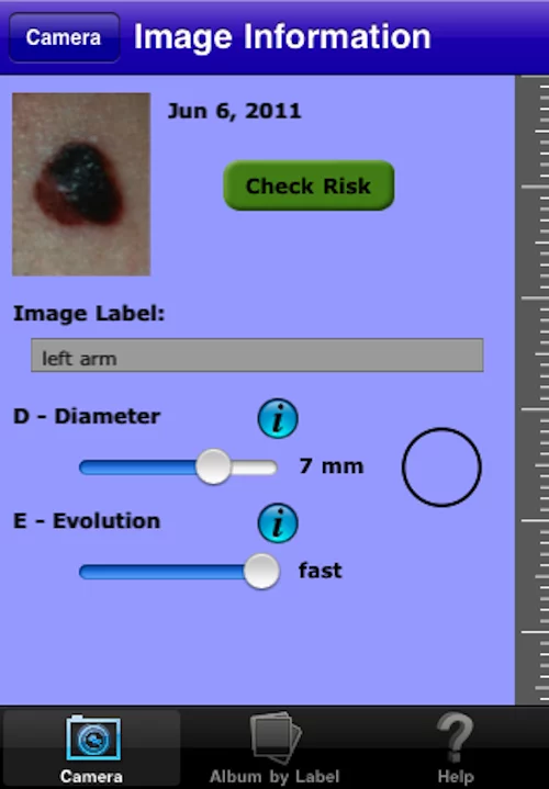 After taking a photo use the sliders to note the diameter and evolution of the mole or freckle