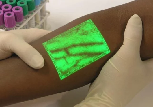 Real-time image of underlying vasculature as seen on the surface of the skin with VeinViewer by Luminetx.
