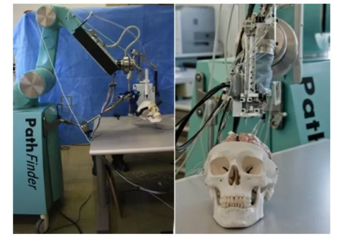 The ROBOCAST Project is developing a robotic system for assisting with keyhole neurosurgery