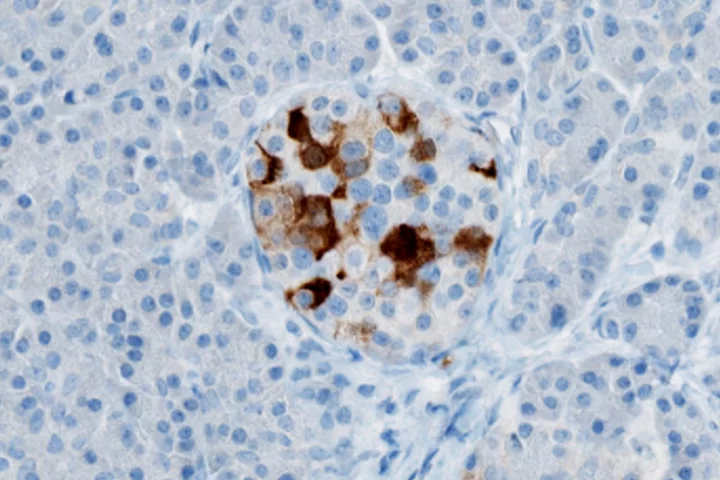 After identifying enteroviruses (shown here in pancreatic tissue in brown) as a possible trigger for the onset of type 1 diabetes, a team has developed a vaccine that could prevent the disease from developing in children