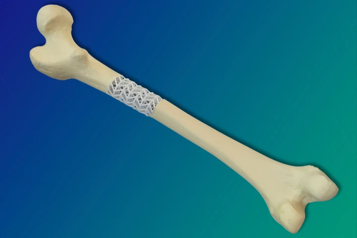 This rendering shows how the material could be used to temporarily replace missing bone at a break site