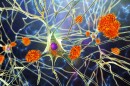 An artist's impression of amyloid plaques forming in the brain, which scientists hope to tackle as a way of treating Alzheimer's