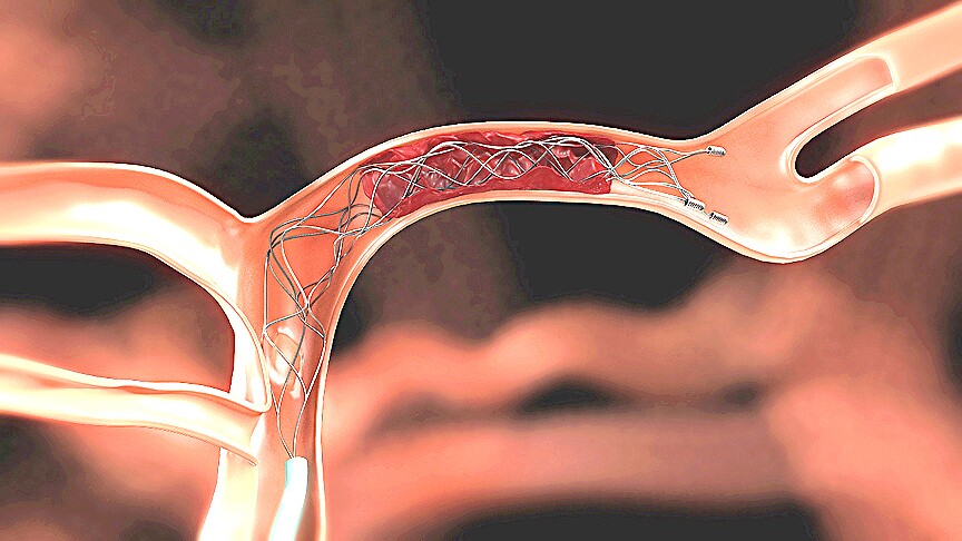 A cerebral blood clot captured by the Solitaire Revascularization Device (Image: Covidien)