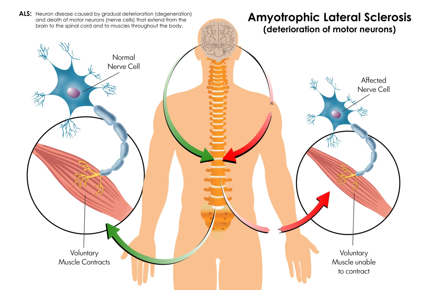 Schematic of how ALS affects nerves and muscles