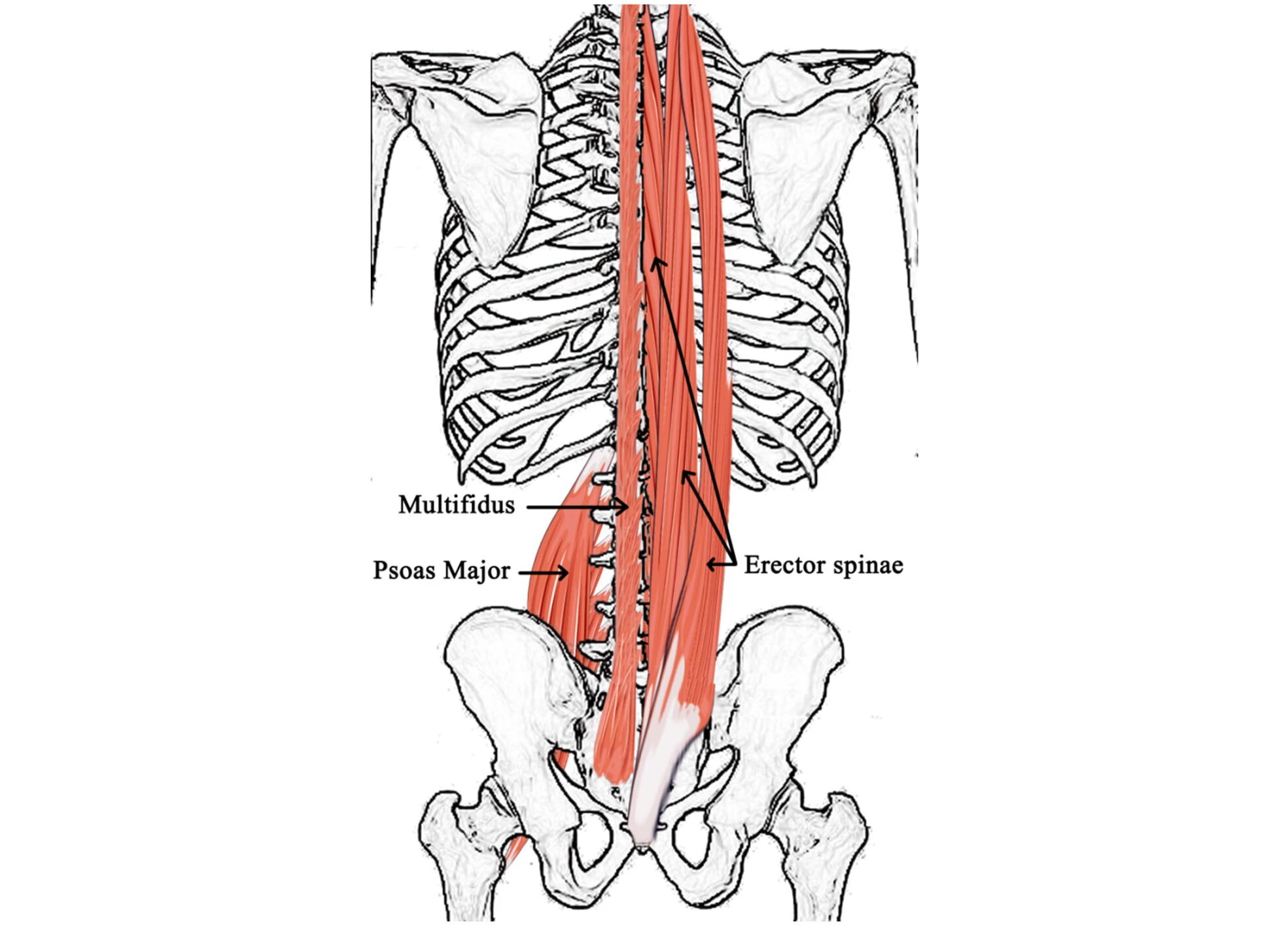 Diagram of the multifidus (MF) and erector spinae (ES) muscles