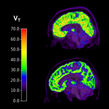 Tracking mGluR5 activity, the scan at the top shows a patient with PTSD and suicidal thoughts, while the bottom scan is a healthy brain with no suicidal thoughts