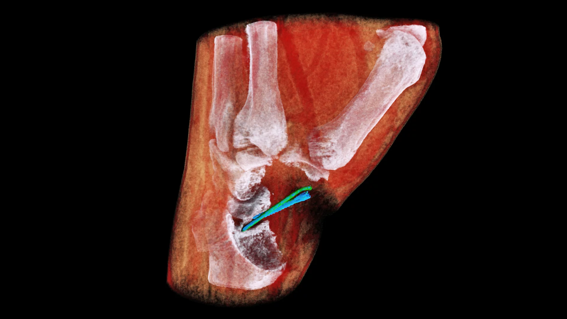 MBI's 3D scanner assigns colors based on different densities of tissue – so bones appear white, muscle appears red and implants appear blue and green