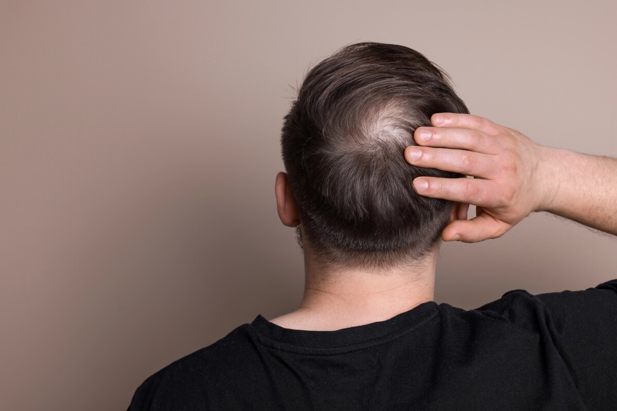 First long-acting hair regrowth pill hailed as 'new benchmark'