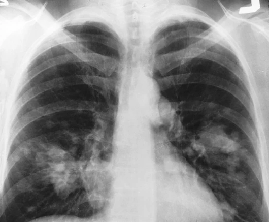 Gold particles are being used in a new breath-testing device to detect lung cancer in patients