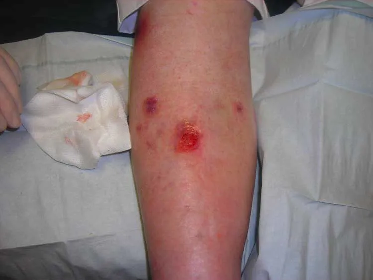 A solution containing skin cells and proteins has been shown to speed the healing of venous leg ulcers