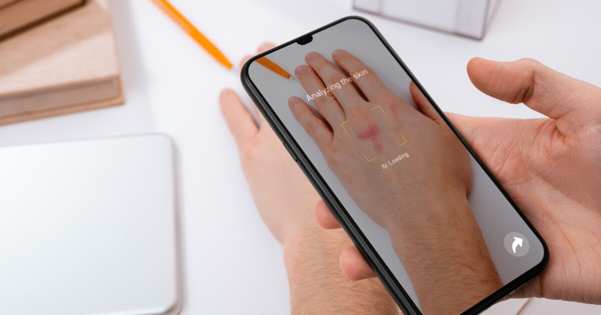 Hand Rashes Scanning Using Phone Images You can now use your phone to ID skin conditions