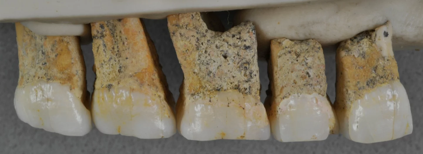 The upper teeth of one Homo luzonensis individual