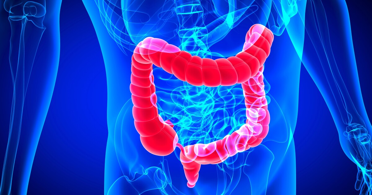 Healthy lifestyle cuts diverticulitis risk by half Healthy lifestyle cuts diverticulitis risk by half