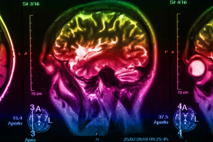 A new study suggests degradation in the brain's serotonin systems could precede visible symptoms of Parkinson's disease by up to 20 years