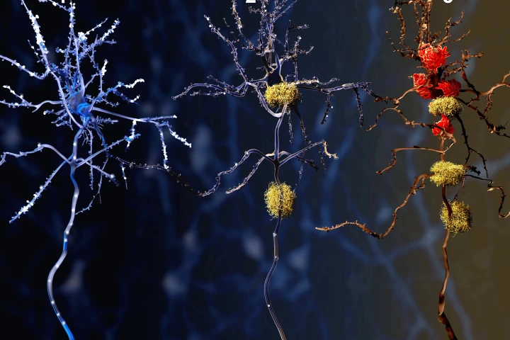 This illustration shows a healthy neuron on the left, a neuron around which amyloid plaques are clumping in the middle, and the resultant dead neuron being digested by specialized cells known as microglia on the right