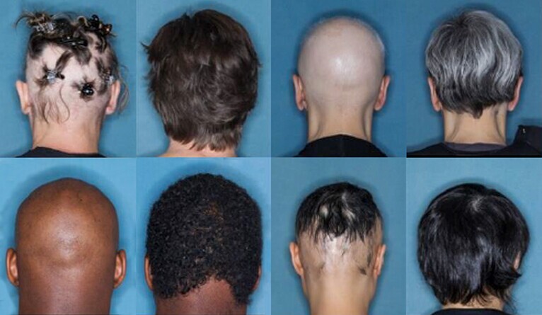 Before and after photos of alopecia patients receiving an experimental treatment across 36 weeks