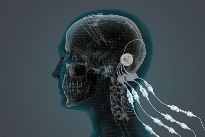 The Convection Enhanced Delivery system consists of four tubes implanted within the brain, all of which are fed by a single skull-mounted external delivery port