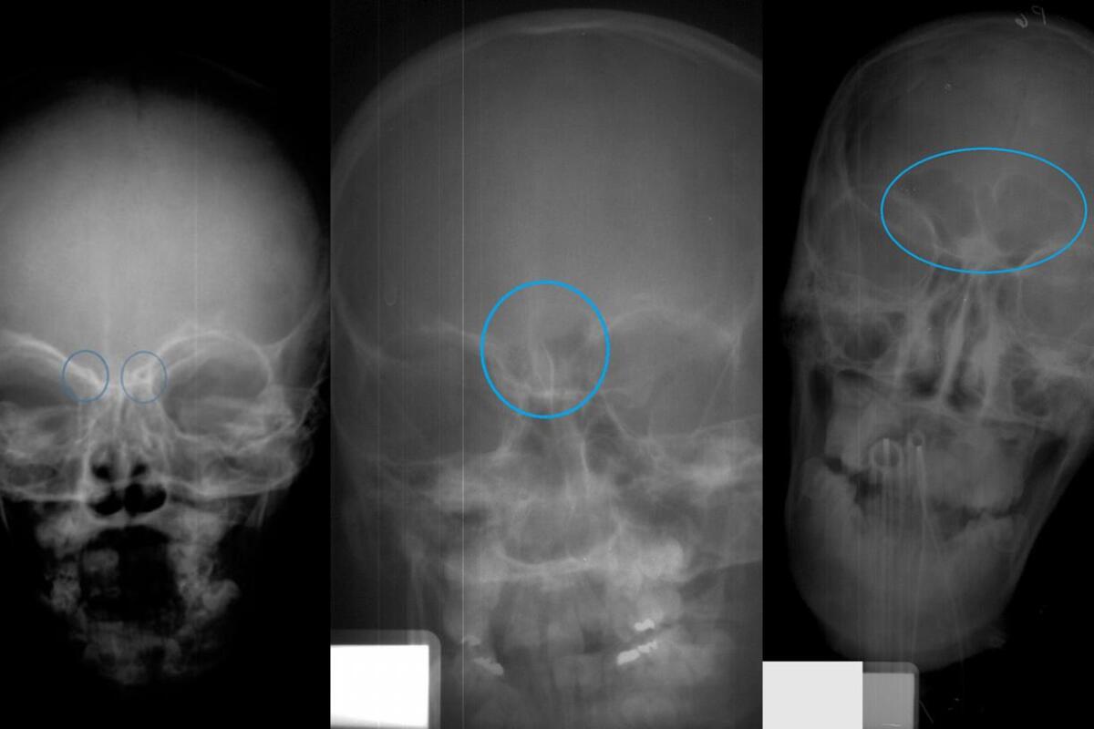Sinus Xrays reveal age of children