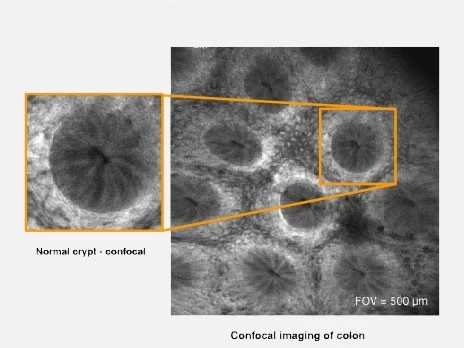The Optiscan confocal Endomicroscope is able to show cells at this high magnification level while they're still in the body, removing the need for biopsy.