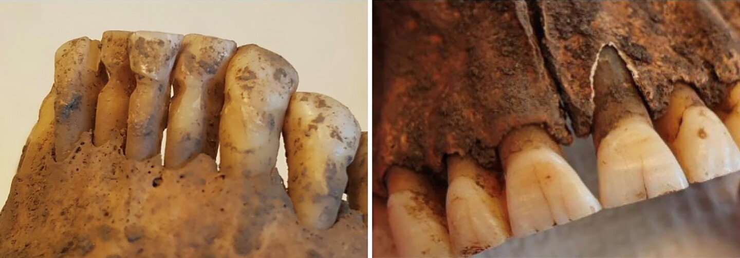Teeth showing signs of habitual toothpick use (left) and filed front teeth (right)