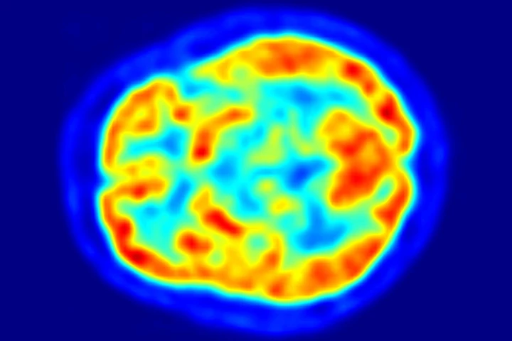 A new algorithm significantly outperformed human clinicians in predicting which patients would go on to develop Alzheimer's disease