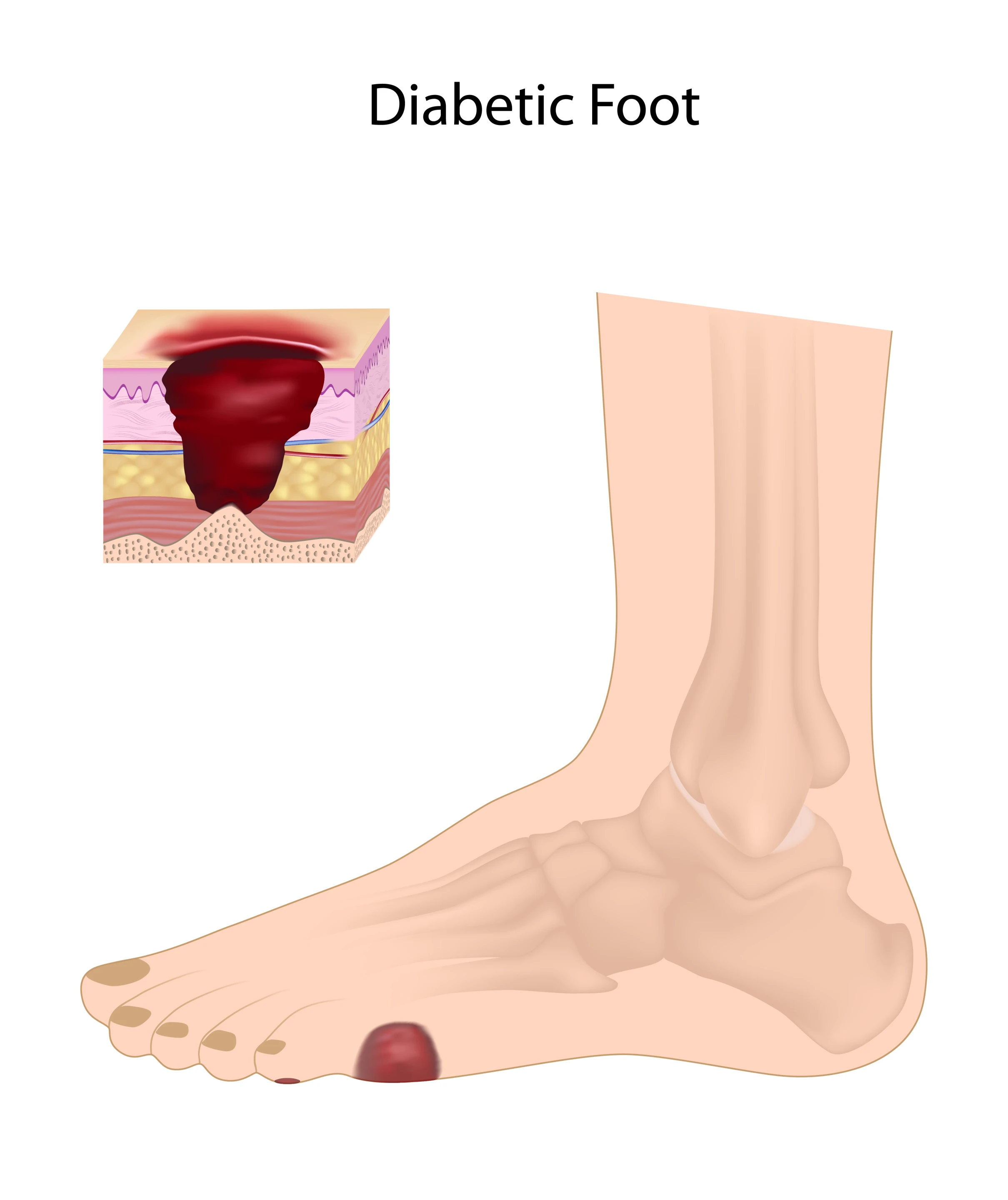 Diabetic foot ulcers may soon be treated with a new drug delivered via a transdermal patch (Image: Shutterstock)