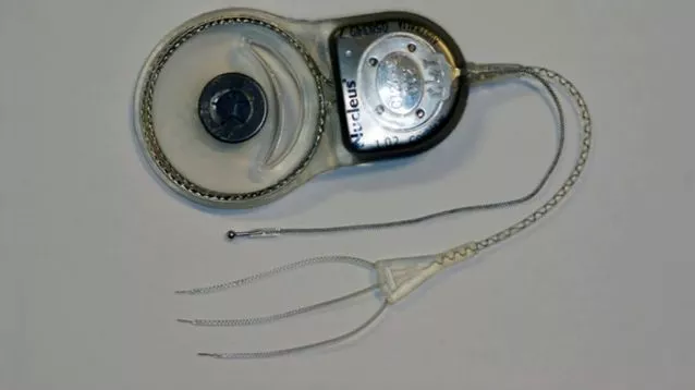 The vertigo-alleviating cochlear implant