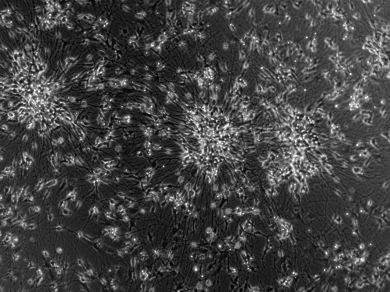 In the study, human-induced stem cells differentiated into neurons representative of those seen in epilepsy