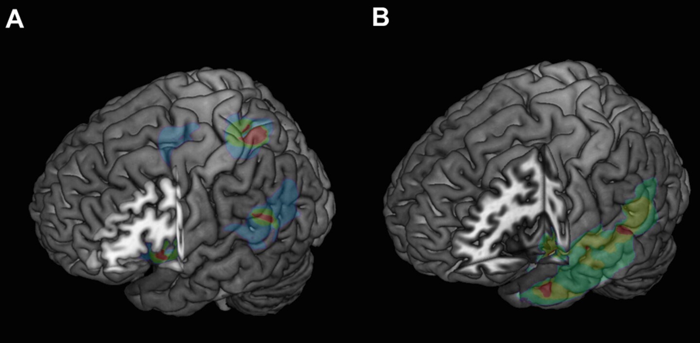 Analysis of lesion overlap between 12 subjects who experienced apparitions, on the left, with a control group, on the right (Image: Current Biology)