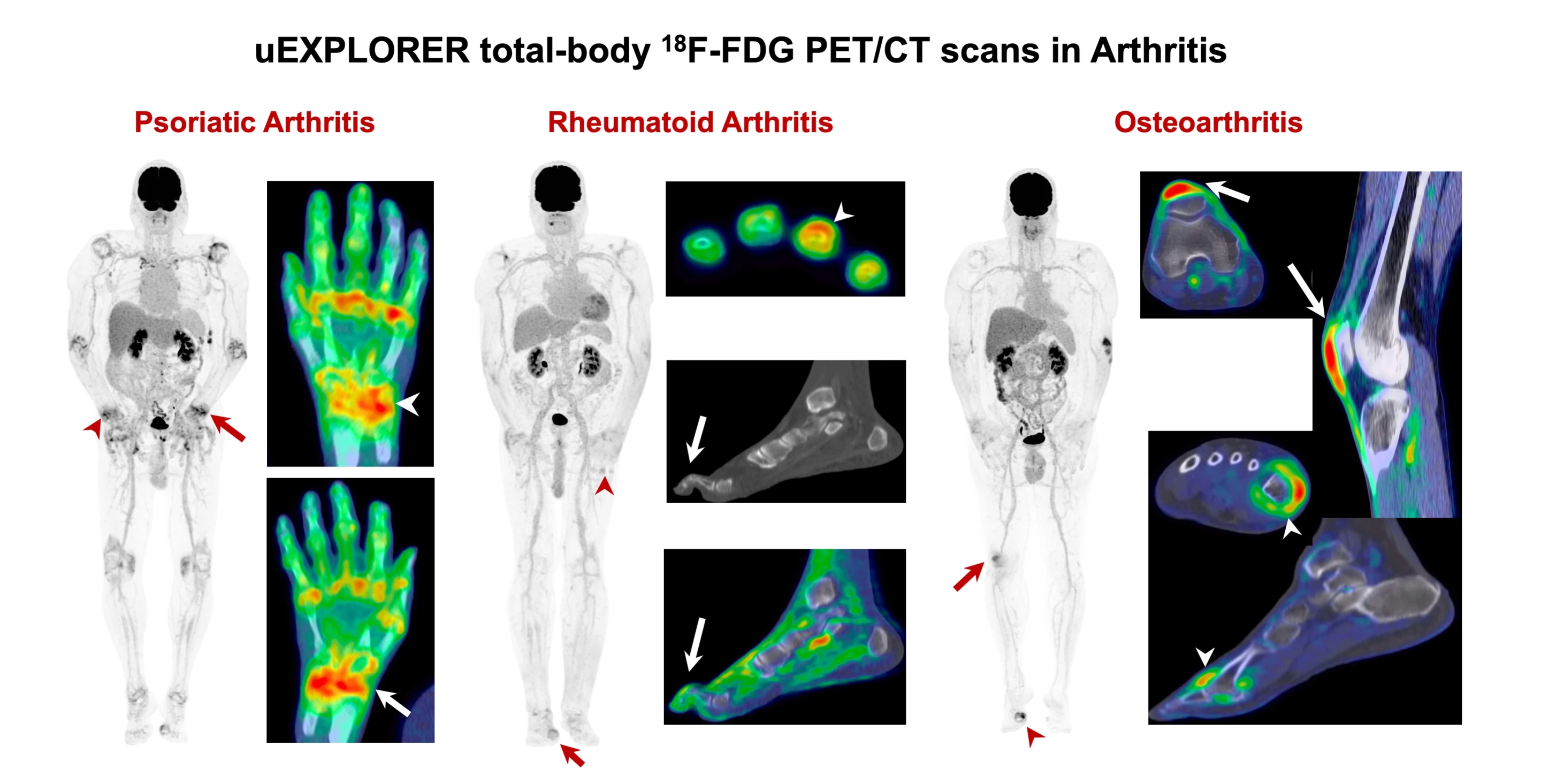 Full-body scans highlight the different systemic inflammatory patterns associated with three kinds of arthritis