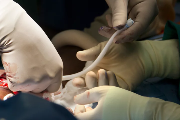 Surgeons at Duke University implant a bioengineered blood vessel in a kidney dialysis patient